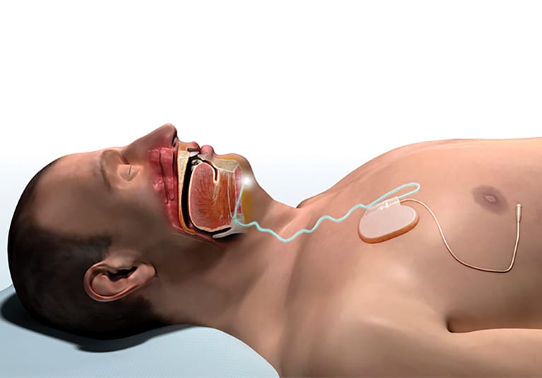 gaining-populthe-emerging-option-of-upper-airway-stimulation-therapy-767.jpg
