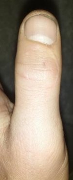 swolen thumb.JPG