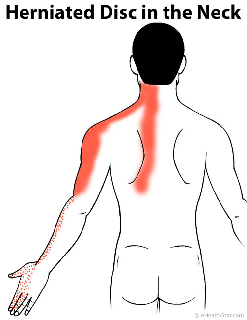 Herniated-disc-in-neck-arm-pain.jpg